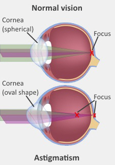 Astigmatism - Health Information And Services